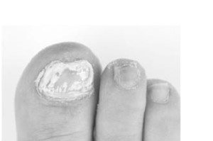 [1a Pharma Nagell.g.Nagelpilz 78,22mg/ml, 6,6 ml